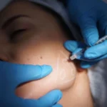 ‘I had 12 vials of Botox injected into my face at age 24 – but it had nothing to do with looks’